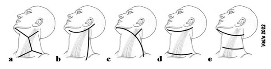 Figura 3. Incisiones históricas para la realización de operaciones comando (31). a) Doble “Y” o de Hayes Martin. b) Gran Colgajo Anterior o de Schobinger. c) Conley. d) Doble de Garriga. e) Mc Fee. Fuente: Elaboración propia por el autor.