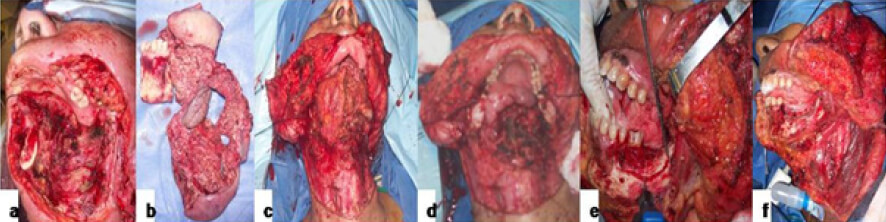 Figura 4. Distintas operaciones combinadas ejecutadas en tumores de cavidad oral. a) Comando por neoplasia de piso de boca. Disección cervical selectiva de los niveles I-III. b) Pieza quirúrgica del anterior en continuidad con la linfadenectomía. c-d) Comando de reborde alveolar. Linfadenectomía selectiva bilateral. e) Resección marginal de maxilar inferior por lesión de mucosa yugal. f) Disección cervical selectiva. Fuente: Imágenes propias del autor.