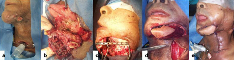 Figura 5. Operación combinada tipo comando para extensa neoplasia de piso de boca. a) Aspecto inicial de la lesión. Se realizó traqueostomía previa. b) Resección del cuerpo lateral derecho de la mandíbula. c) Se emplazó placa de metal sobre la mandíbula. d) Rotación de colgajo musculocutáneo pectoral para cubrir el área de defecto. e) Resultado final de la reconstrucción. Fuente: Imágenes propias del autor.