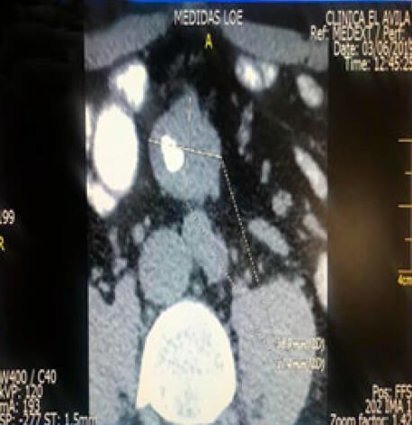 Imagen 1. Cúmulo Cálcico Grueso/ TAC Abdominal
(Medidas de LOE)