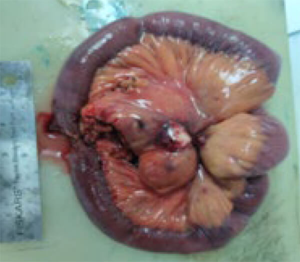 Imagen 2. LOE en Mesenterio Sólido / TAC Abdominal