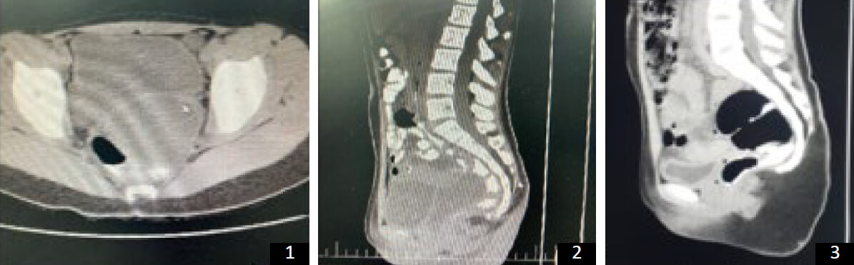 Imágenes 1, 2 y 3. Imágenes de TAC abdominopelvica.