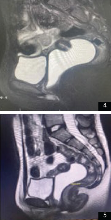 Imágenes 4 y 5. Imagen de RMN.