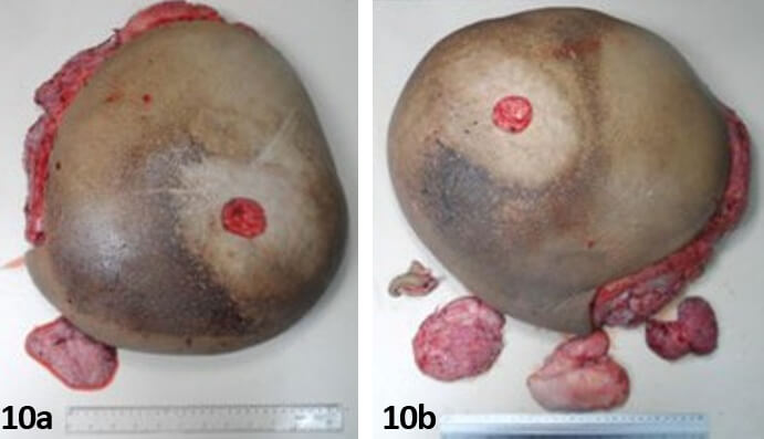 Figura 10. 10a, Pieza operatoria correspondiente a la resección mamaria derecha. 10b, Pieza operatoria correspondiente a la resección mamaria izquierda.