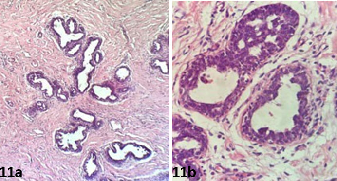 Figura 11. 11a, Hematoxilina/Eosina, microscopia óptica, 20X. Figura 11b, Hematoxilina/Eosina, microscopia óptica, 40X : Imagen del examen anatomopatologico de la biopsia del espécimen quirúrgico respectivamente izquierda y derecha). La sección microscópica evidencia un aspecto similar al visto en la ginecomastia, sin atipias, con fibrosis estromal y proliferación pseudoangiomatosa.