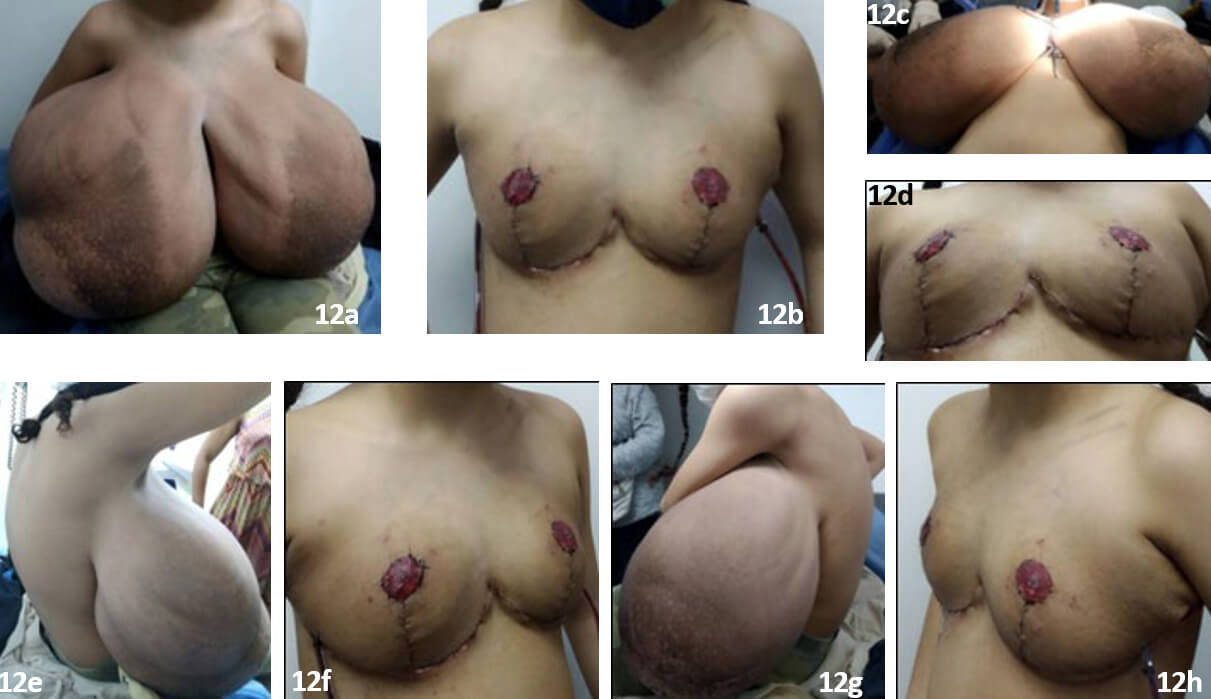 Figura 12: Fotografías antes y después de la cirugía: cambios experimentados en la paciente, fig 12a y 12b, proyección frontal, fig. 12c y 12d, proyección caudo-craneal, figura 12e y 12f, proyección oblicua-lateral derecha y figura 12g, 12h, oblicua-lateral izquierda.