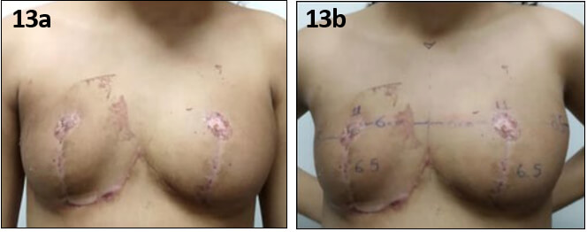 Figura 13. 13a, fotografía en postoperatorio (6 semanas), se aprecian laceraciones por irritación secundaria a la cura oclusiva en polo superior de la mama derecha y aumento leve de volumen a predominio de mama izquierda. 13b, El complejo areola-pezón se mantiene en su ubicación inicial en forma simétrica, pero sobre una mama que comienza el recrecimiento.