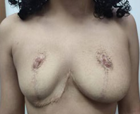 Figura 14. Foto actual, enero 2023, se aprecia asimetría de las mamas, con mayor volumen la izquierda.