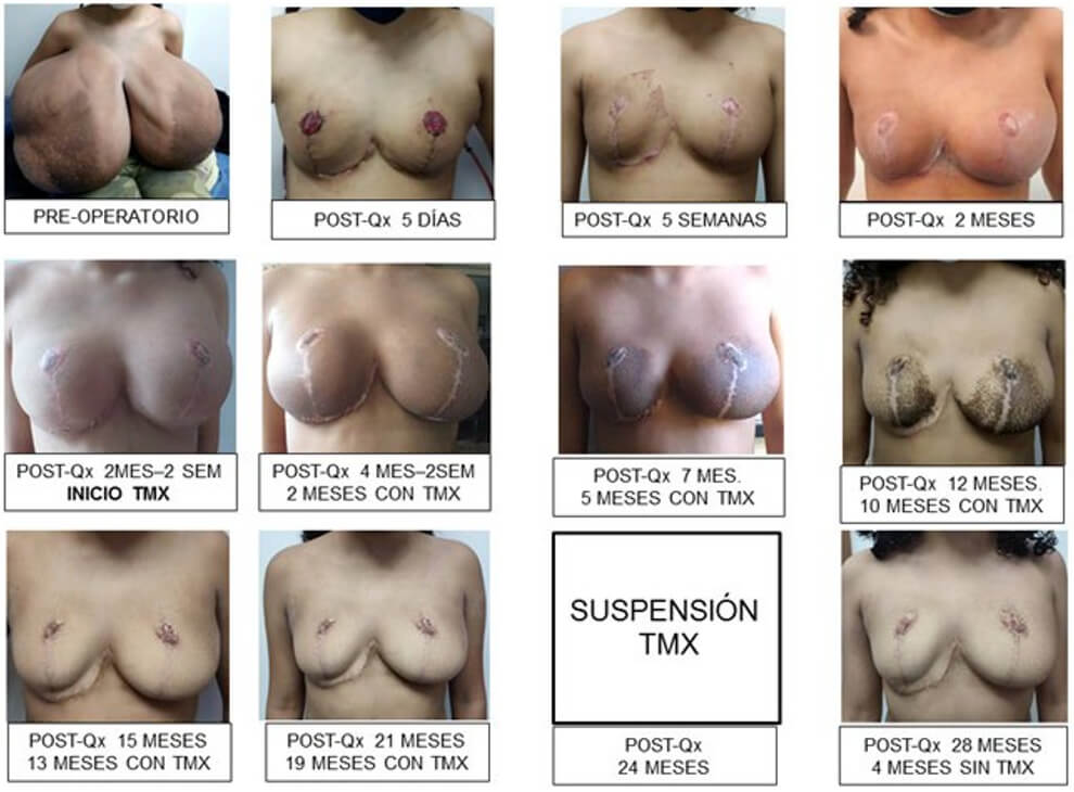 Figura 15. Secuencia fotográfica de la paciente desde el momento que consulta por el cuadro de hipertrofia mamaria hasta la finalización de su tratamiento hormonal. Nótese inicialmente el cambio de volumen pre y post.quirúrgico (POST-Qx= post. quirúrgico). El crecimiento posterior a la cirugía. La mejoría con el tratamiento (TMX= Tamoxifeno). Y la estabilización del volumen mamario posterior a la suspensión del tratamiento con Tamoxifeno.