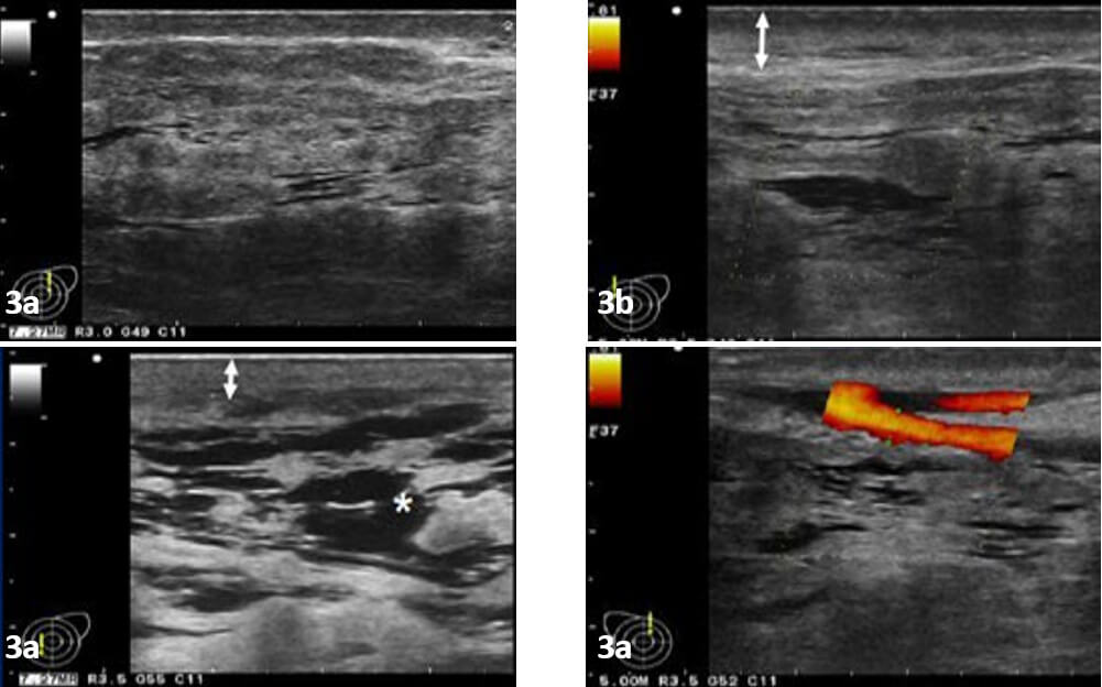 Figura 3. 3a, Abundante tejido fibro-glandular, 3b, engrosamiento de la piel (doble flecha blanca), 3c, mamas congestivas (asterisco *) 3d, vasculatura mamaria prominente (Imagen Doppler).