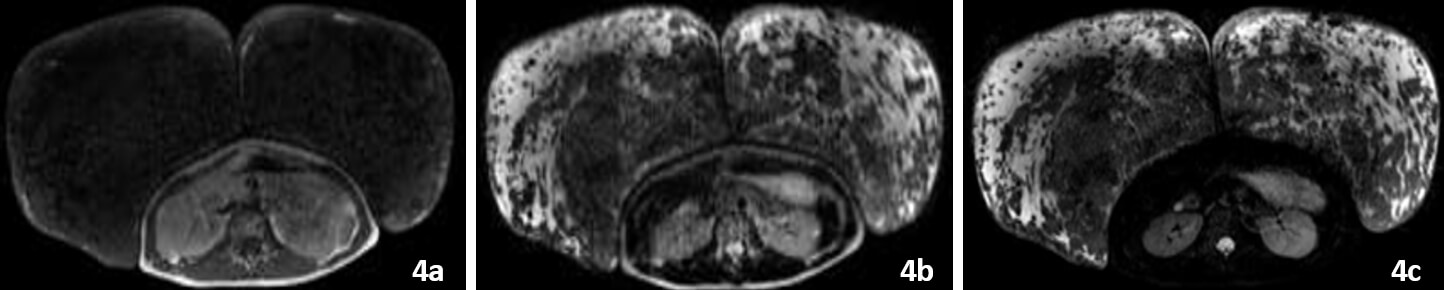 Figura 4. Resonancia Magnética de Mama. Fig 4a, T1 con ambas mamas predominantemente hipointensas en relación con escaso tejido graso. Fig 4b y 4c, En T2 la hiperintensidad del tejido mamario sugiere proceso congestivo confirmándose en secuencias T2 STIR (Equipo Resonador Magnético Phillips 1,5T) (Fue necesario el uso de antena para tórax en vista de que volumen superaba capacidad de antena para mama).