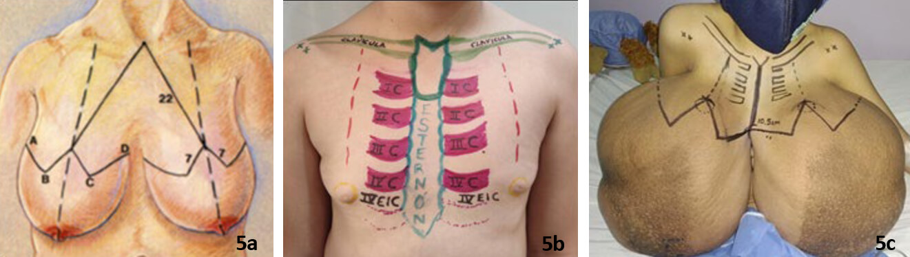 Figura 5. 5a, planificación preoperatoria con patrón de mamoplastía reductora con injerto de complejo areola-pezón. La longitud de los colgajos superiores (A a B más C a D) debe ser aproximadamente igual a la longitud del pliegue inframamario para lograr una forma cónica adecuada al cierre. (Tomado de: Operative Techniques in Plastic and Reconstructive Surgery, Vol 3, No 3 (August), 1996: pp 184-188). Figura 5b: Las estructuras óseas son las mejores referencias en la marcación de la posición normal de la mama, ya que se trata de tórax en crecimiento y las medidas no coinciden con las estándares de la mama femenina adulta. IC, IIC, IIIC, IVC: costillas con la numeración romana correspondiente. EIC: Espacio intercostal. El IV (cuarto) espacio intercostal corresponde con la ubicación normal del complejo areola-pezón. Fig 5c, Marcaje preoperatorio sobre el tórax de la paciente, tomando las referencias señaladas.
