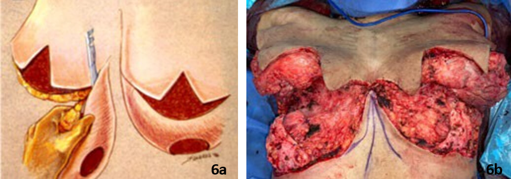 Figura 6. 6a, resección parenquimatosa. La piel superior no debe socavarse excesivamente, sino biselar la resección y así dejar suficiente volumen para la forma adecuada del seno. (Tomado de: Operative Techniques in Plastic and Reconstructive Surgery, Vol 3, No 3 (August), 1996: pp 184-188). 6b, Fotografía intraoperatoria de la paciente, imagen resultante de la resección parenquimatosa bilateral.