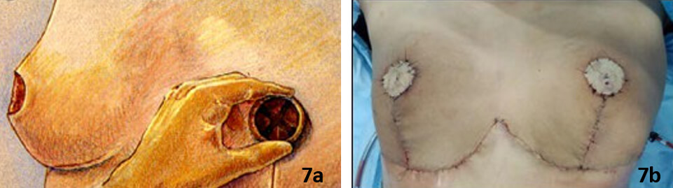 Figura 7. 7a, Determinación de la posición del injerto areola-pezón. Esto se determina mejor, después de dar la forma cónica a la mama. (Tomado de: Operative Techniques in Plastic and Reconstructive Surgery, Vol 3, No 3 (August), 1996: pp 184-188). 7b, Fotografía intraoperatoria de la paciente para señalar la ubicación definitiva del injerto autólogo del complejo areola-pezón.