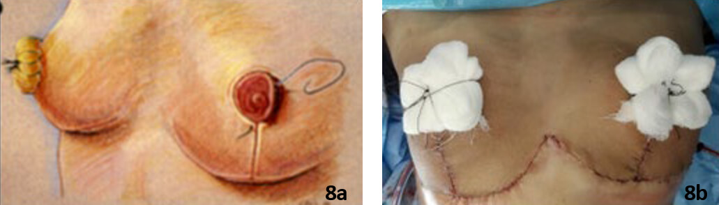 Figura 8. 8a, inmovilización del injerto con “apósito atado” (Tomado de: Operative Techniques in Plastic and Reconstructive Surgery, Vol 3, No 3 (August), 1996: pp 184-188).8b, fotografía intraoperatoria de la paciente con el correspondiente “apósito atado”.