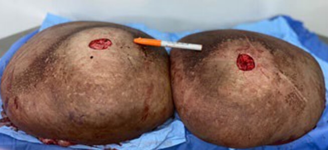 Figura 9. Pieza operatoria correspondiente a la resección mamaria bilateral. Nótese la zona de defecto en el centro de cada mama, que corresponde a la extracción del complejo areola-pezón para su inmediato injerto en el nuevo montículo mamario.