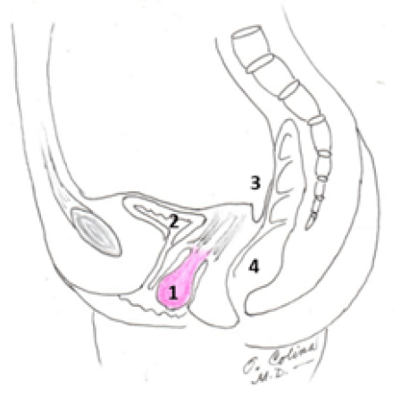 Fig. 2. Prolapso de Cúpula Post histerectomía