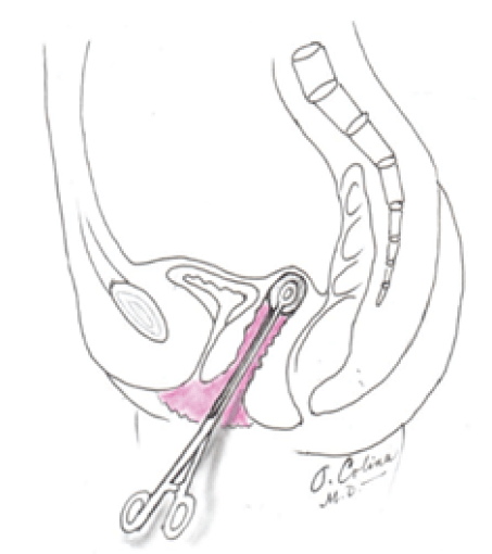 Fig. 3. Reducción del prolapso con torunda