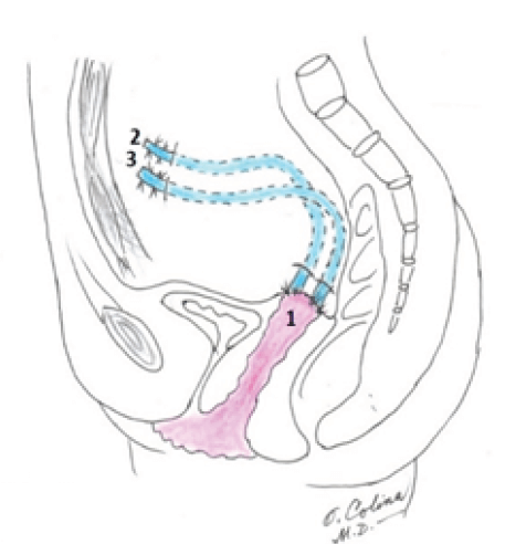 Fig. 4. Fijación de la cúpula vaginal