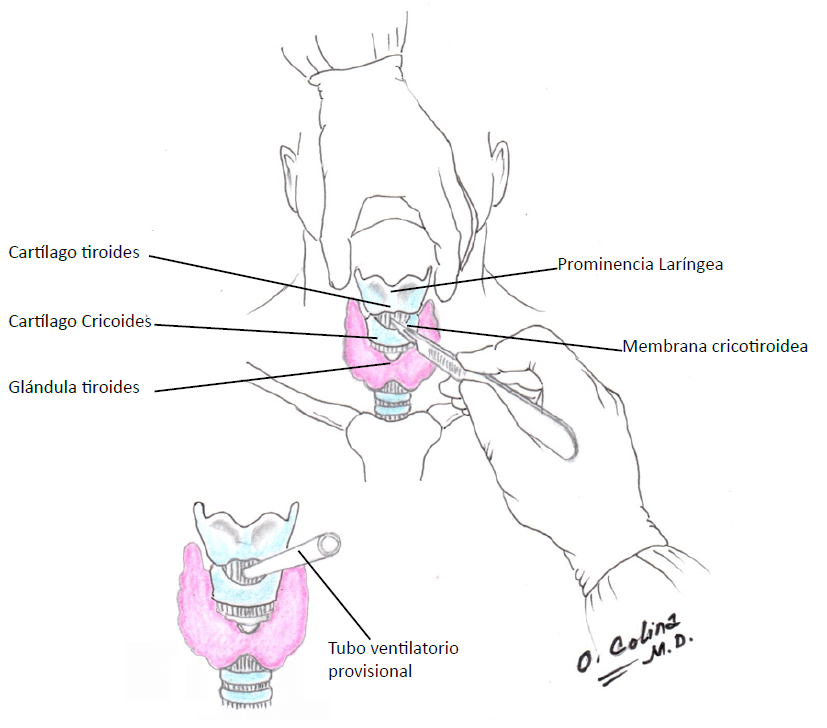 Dibujo imitado de: Bradley Chappell, DO. MHA, Harbor-UCLA medical Center feb 2023.