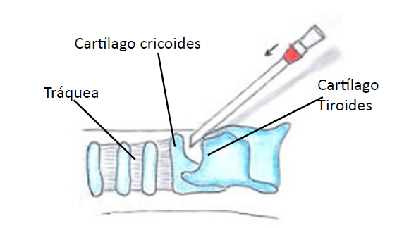 Figura 1. Aguja con Catéter no 14 tipo Jelco