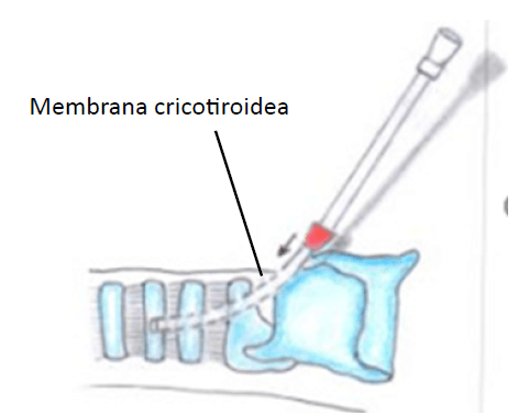 Figura 2. Extracción de la aguja e inserción del catéter en la tráquea