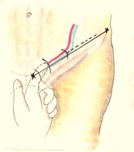 Figura 2. Introducción del índice izquierdo en la raíz del escroto para localizar el orificio superficial del conducto inguinal