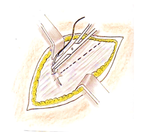 Figura 3. Exposición de la aponeurosis del Oblicuo
externo y colocación de un punto de protección del
conducto inguinal (punto de Grimaldi).