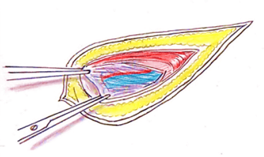 Figura 4. Sección del cremáster y tracción de la fascia espermática interna con dos pinzas de Crile rectas