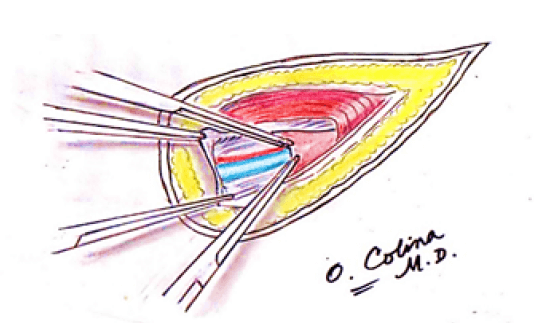 Figura 5. Sección de la fascia espermática interna y tracción y sección de la fascia vascular del abdomen para exponer la vena y la arteria testicular izquierda