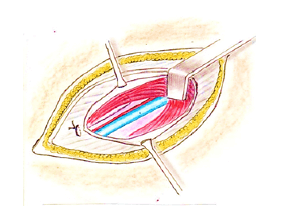 Figura 6. Visualización de vena y arteria testicular izquierda