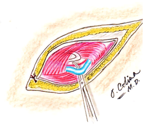 Figura 7. Disección de la vena testicular y conservación de la arteria testicular indemne. Visualización del codo del conducto deferente