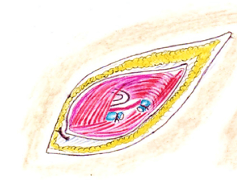 Figura 8. Sección y ligadura de la vena espermática.
