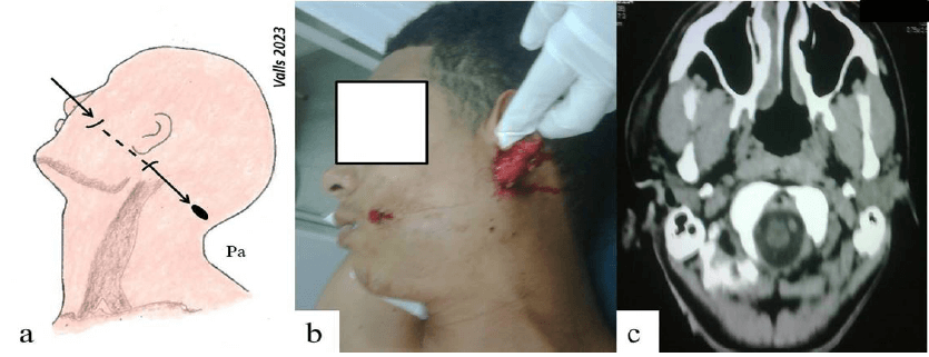 Figura 4. a y b). Esquema e imágenes de paciente atendido por el autor con herida por proyectil detonado por arma de fuego que ingresa en región geniana y sale por región parotídea. c) Tomografía axial computarizada de las áreas afectadas donde se evidencia edema de partes blandas, sin compromiso vascular.