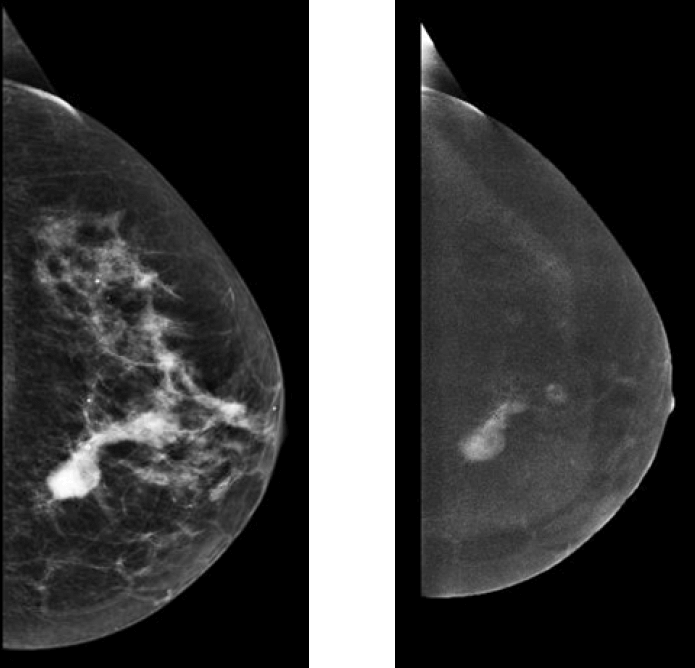 Figura 4. Imágenes de mamografía con contraste donde se evidencian dos lesiones que captan contraste iodado, en relación con focos de tumor.