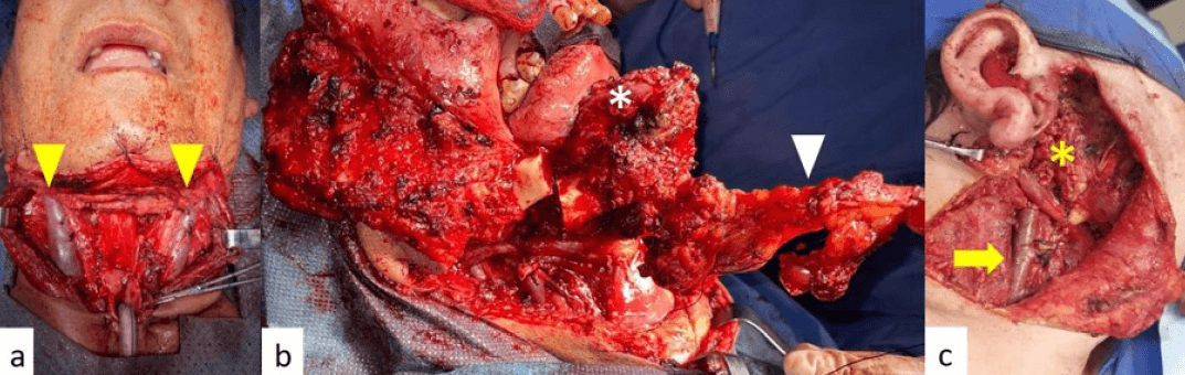 Figura 3. Imágenes de procedimientos radicales en neoplasias primarias con las correspondientes disecciones ganglionares de cuello. a. Laringectomía total por trazo quirúrgico en delantal. Puntas de flechas amarillas, disección ganglionar de cuello selectiva del II-IV bilateral. b. Operación tipo COMMAND por herida quirúrgica de Conley bilateral. Asterisco blanco, maxilectomía inferior. Punta de flecha blanca, disección ganglionar de cuello selectiva del I-III bilateral. c. Extirpación de recaída regional de tumor de parpado en glándula parótida (PAFC) por incisión cérvicofacial de colgajo superior adaptable. Asterisco amarillo, parotidectomía total con sacrificio del nervio espinal. Flecha amarilla, disección ganglionar de cuello selectiva del I-III.