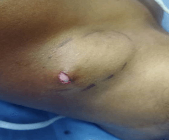 Figura 1. Marcación con tinta indeleble del lipoma en región de hombro derecho.