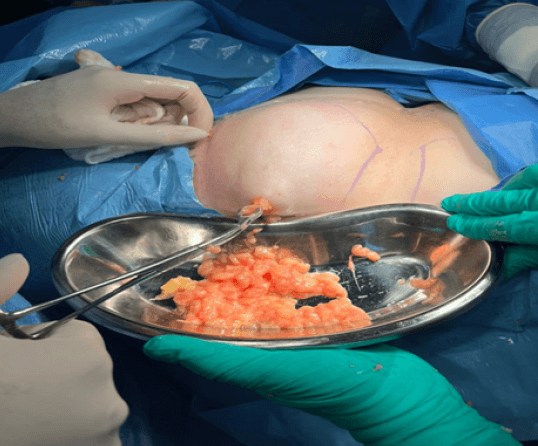 Figura 5. Exéresis de lipoma en región torácica superior derecha a través de la mínima incisión con pinza de aro y cureta de Novak. (misma paciente de figura 4).