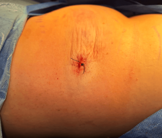 Figura 6. Postoperatorio inmediato de Exéresis de Lipoma en región torácica superior derecha según técnica de MIS. (paciente figura 4)