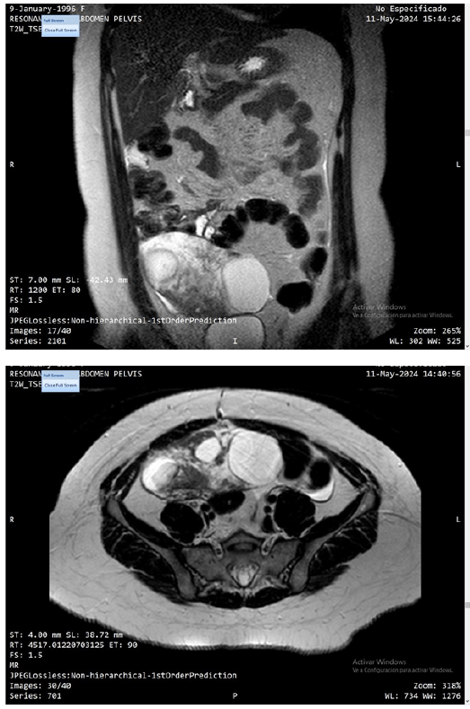 Figura 1. Resonancia magnética de abdomen y pelvis