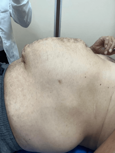 Figura 1. Paciente en el cual se evidencia aumento de volumen abdominal con presencia de saco herniario de 15x10cm aproximadamente.