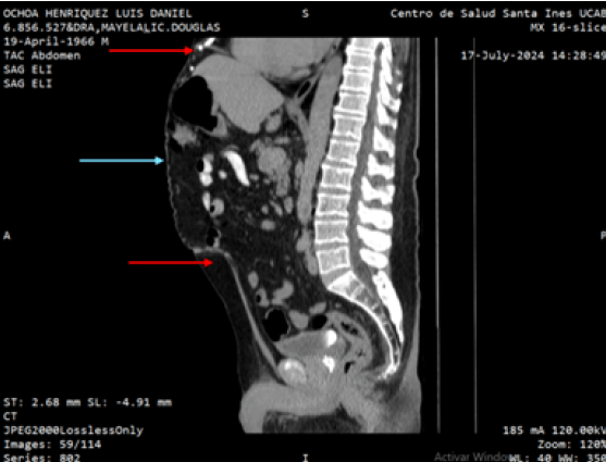 Figura 2. Tomografía computarizada en plano sagital que revela una solución de continuidad de la aponeurosis (flechas rojas) con eventración abdominal (flecha azul) de contenido de grasa y asas intestinales delgado.
