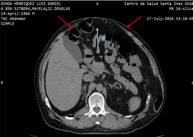 Figura 3. Tomografía computarizada en plano axial revela una solución de continuidad de la aponeurosis (flechas rojas) con eventracion abdominal (flecha azul) de contenido de grasa y asas de intestino delgado.