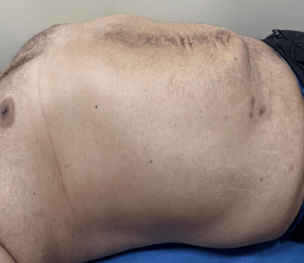 Figura 6. Paciente posterior a 16 días de NPP, donde se evidencia reducción satisfactoria del contenido abdominal.