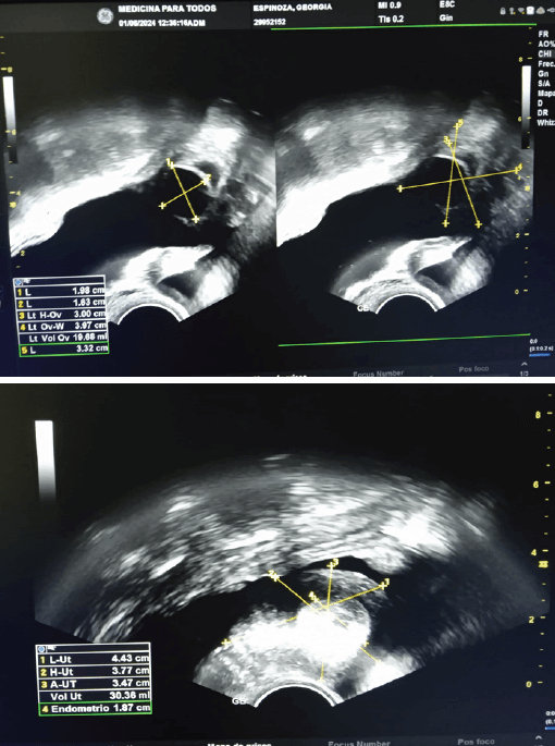 Figura 1. Ultrasonido transvaginal