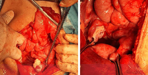 Figura 3. Hallazgos intraoperatorios