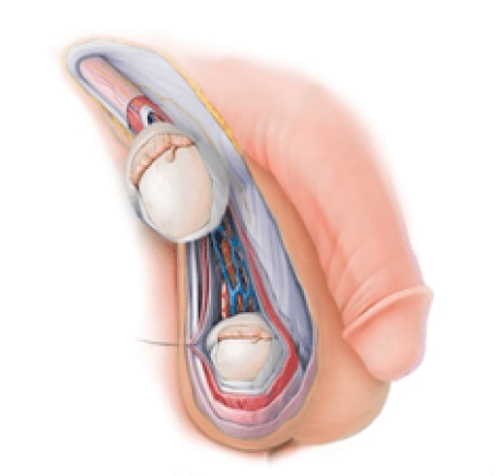 Figura 1. Criptorquidia con Poliorquidismo tipo 2