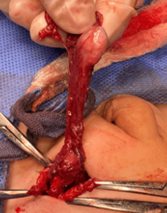 Figura 2. Hallazgos de la cirugía, compatible con tipo 2.