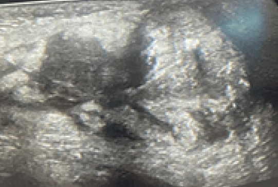 Figura 4. Ecosonograma control semana de postoperatorio, ambos testículos en hemiescroto correspondiente