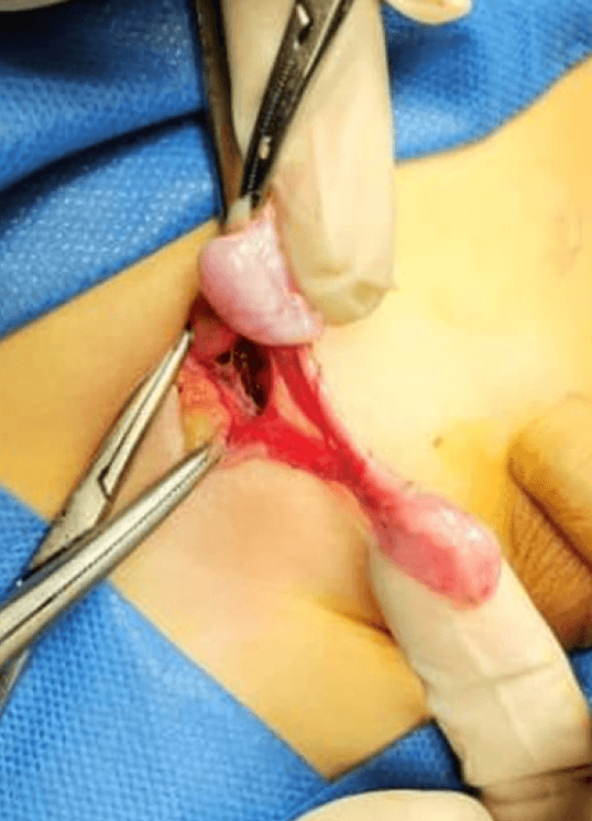 Figura 6. Segundo paciente. Hallazgos de cirugía.